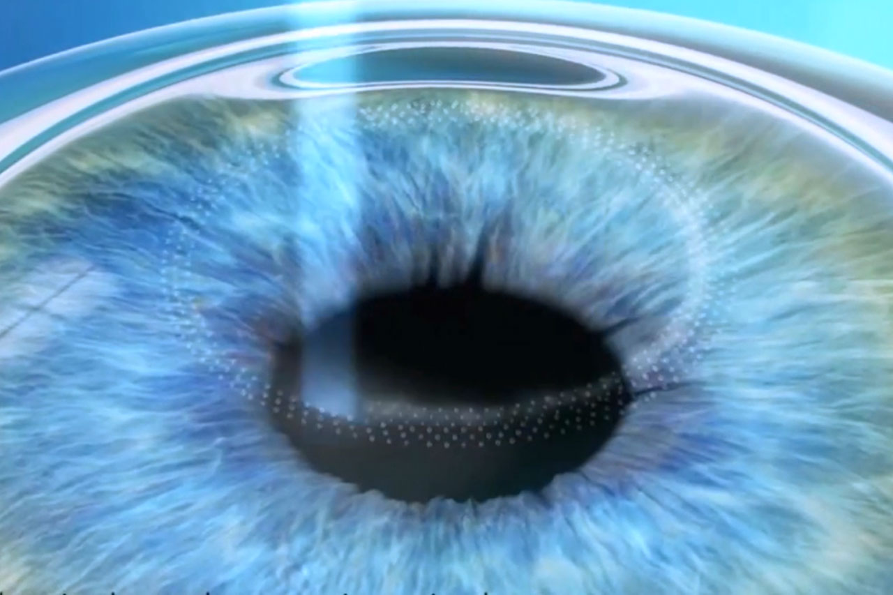 Refractive Video Image
